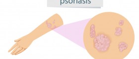 What You Should Know About Psoriatic Arthritis: Causes, Symptoms, Diagnosis, And Treatment